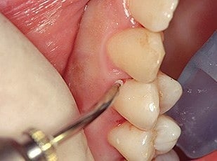 エルビウムヤグレーザー歯科
