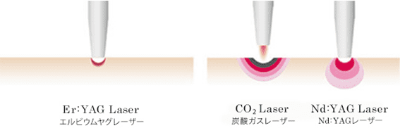 エルビウムヤグレーザー